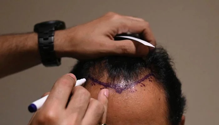 Hair Transplant London – Expert Care at Westminster Medical Group