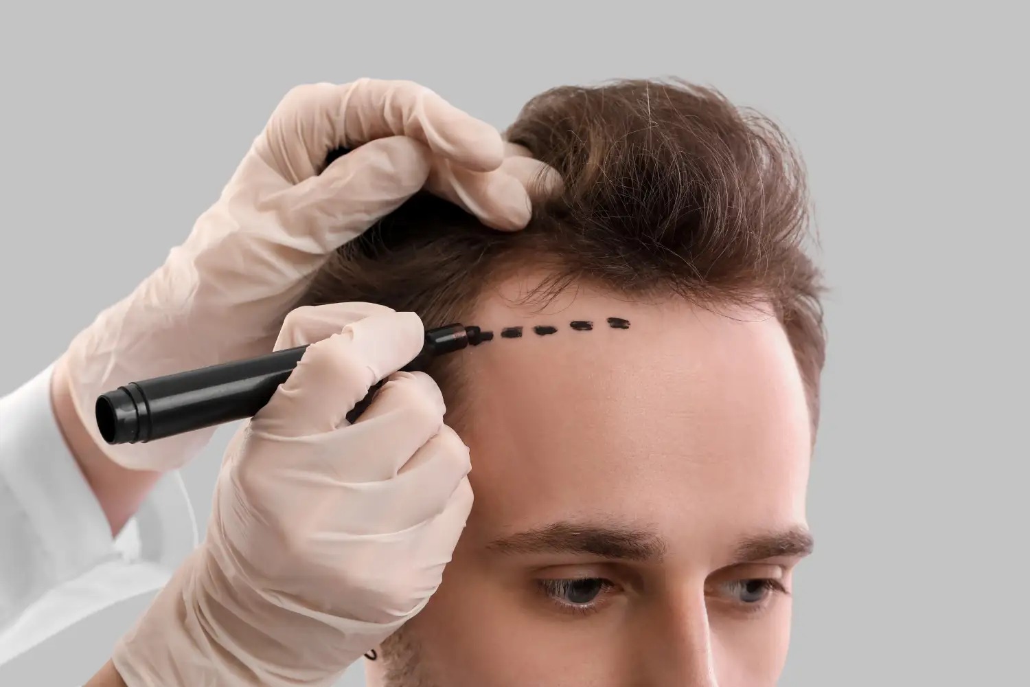 Sapphire Hair Clinic – Best Place for Hair Transplant Turkey